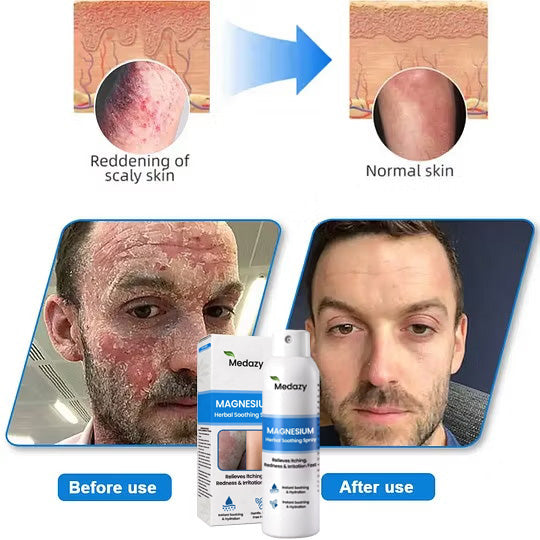 ✅ Official Store: Medazy® Magnesium Herbal Spray – Fast Relief for Psoriasis & Eczema | No-Rub, Steroid-Free