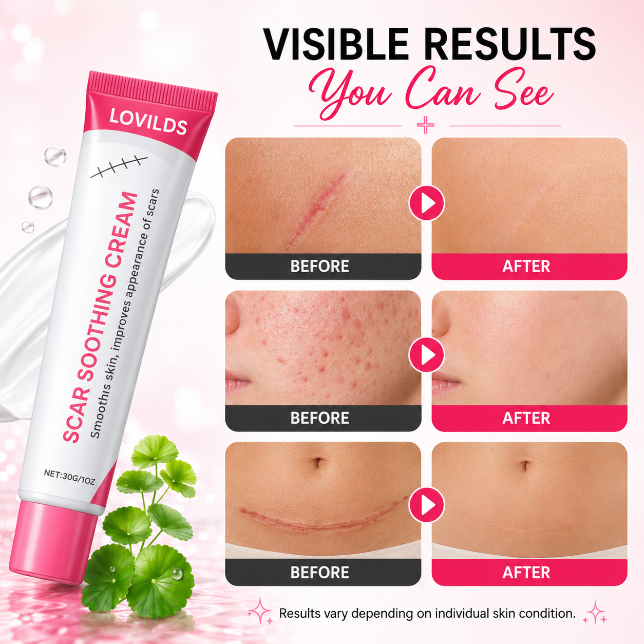 Scar free wart removal cream
