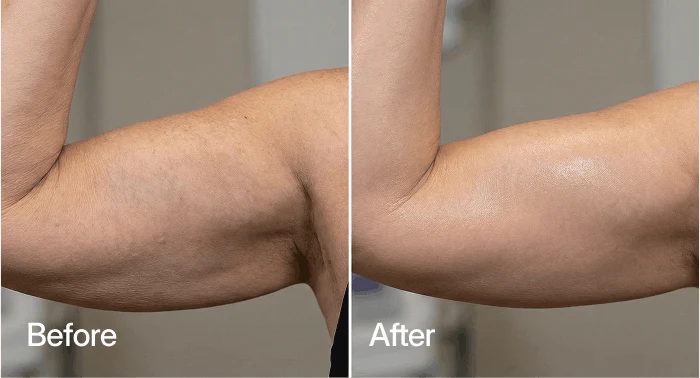 Before and after appearance of upper arm skin